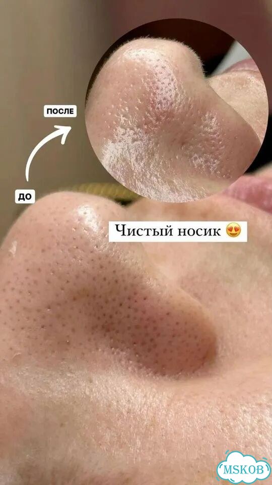 Механическая чистка лица фото 3