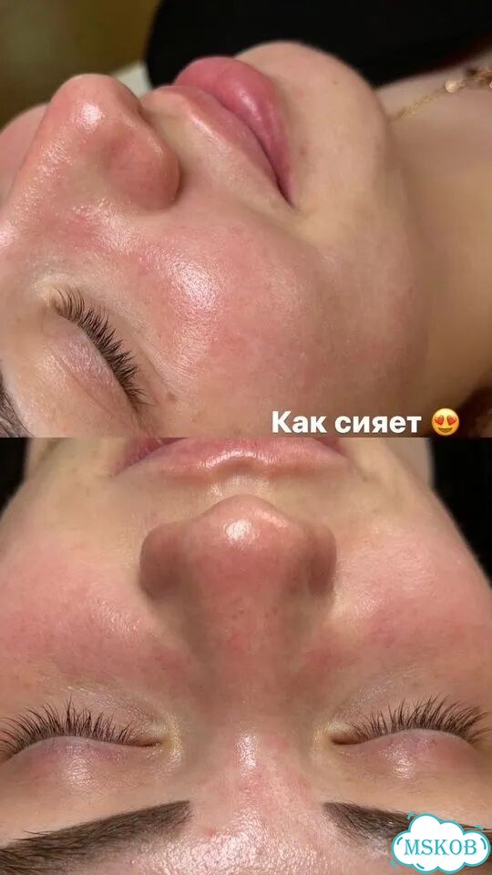 Механическая чистка лица фото 9